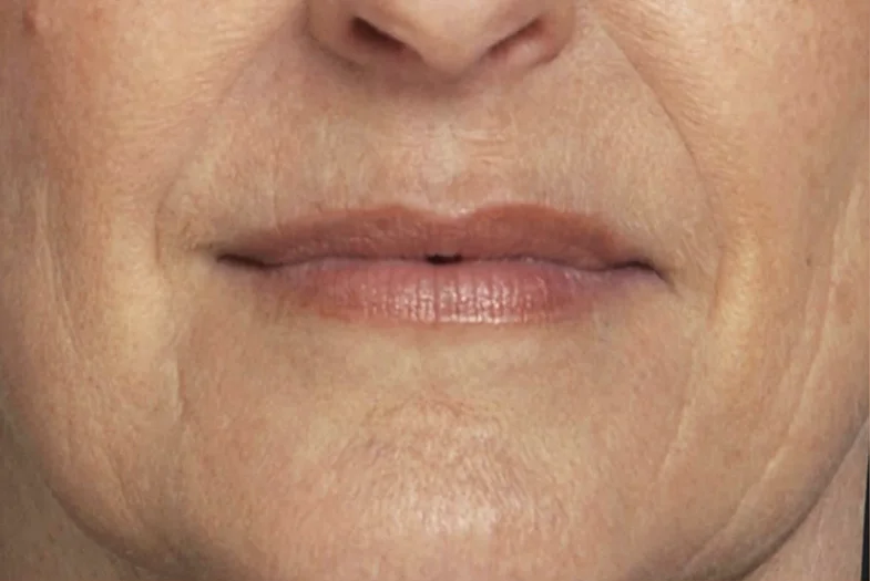 Brighter and more radiant skin after BelleGlow professional application.