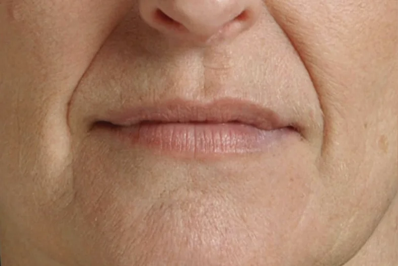 BelleGlow before treatment Dull and uneven skin appearance before BelleGlow professional treatment.