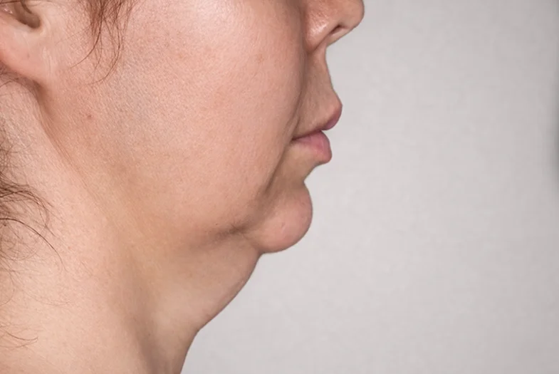 BelleVline before treatment Loss of facial definition before BelleVLine peptide® treatment.